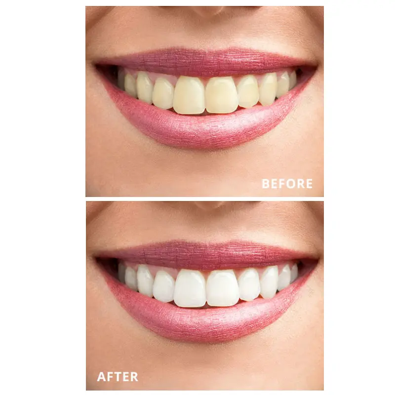 Teeth Whitening Mouth Tray Dual Soft Tray  GW-MT03 004tsn